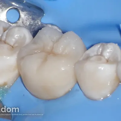 Complex Lower Molar Retreatment - Image 19