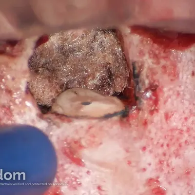 Apical Microsurgery of Upper Molar Mesiobuccal Root - Image 2