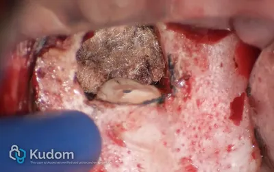 Microchirurgia Apicale Radice Mesio-Vestibolare di Molare Superiore - Immagine 2