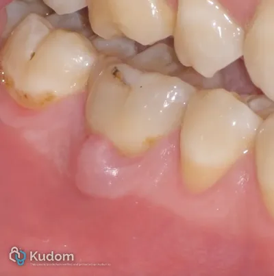 Ritrattamento Complesso Molare Inferiore - Immagine 2