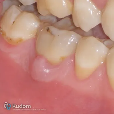 Complex Lower Molar Retreatment - Image 2