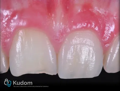 Rigenerazione Pulpare Centrale Superiore - Immagine 2