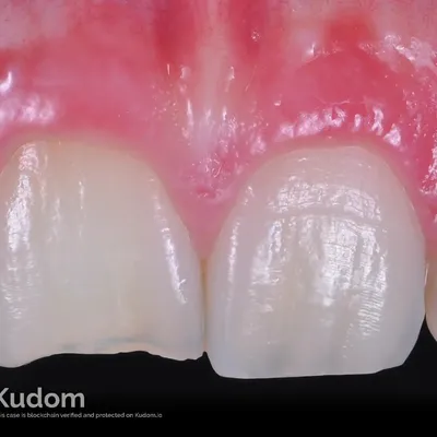 Upper Central Incisor Pulp Regeneration - Image 2