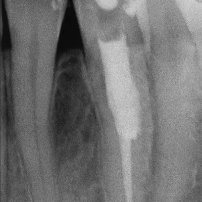Lower Canine External Resorption - Image 2