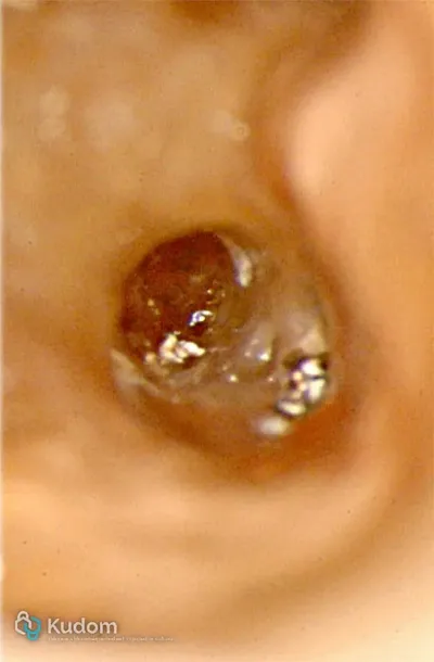 Perforazione Iatrogena Molare Inferiore - Immagine 2