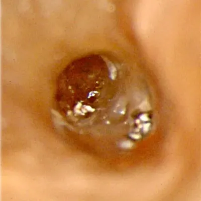 Lower Molar Iatrogenic Perforation - Image 2