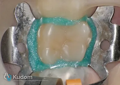 Terapia Canalare Molare Superiore - Immagine 2