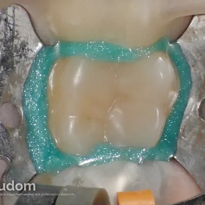 Upper Molar Root Canal Treatment - Image 2