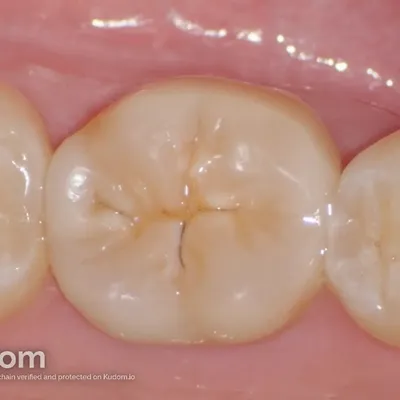 Complex Lower Molar Retreatment - Image 20