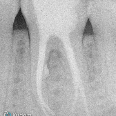 Complex Lower Molar Retreatment - Image 21