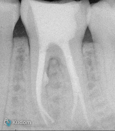 Ritrattamento Complesso Molare Inferiore - Immagine 21