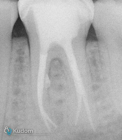 Ritrattamento Complesso Molare Inferiore - Immagine 22