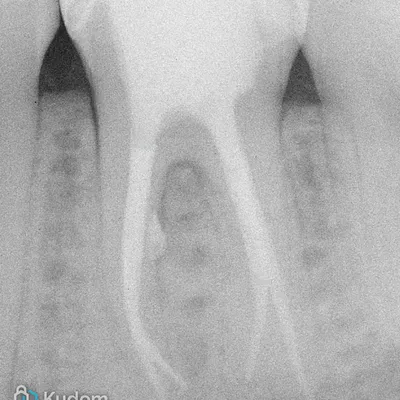 Complex Lower Molar Retreatment - Image 22