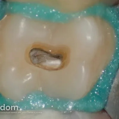Upper Molar Root Canal Treatment - Image 3
