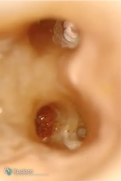 Perforazione Iatrogena Molare Inferiore - Immagine 3