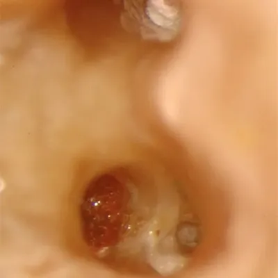 Lower Molar Iatrogenic Perforation - Image 3