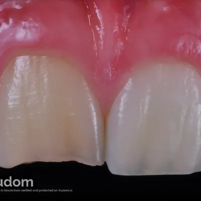 Upper Central Incisor Pulp Regeneration - Image 3