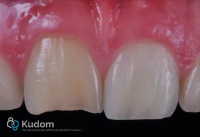 Rigenerazione Pulpare Centrale Superiore - Immagine 3