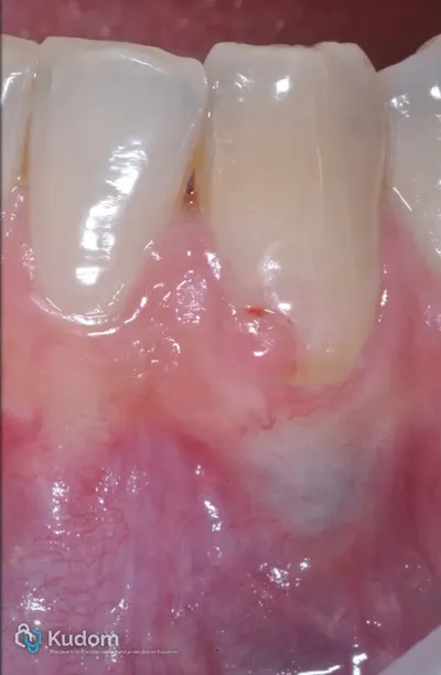 Riassorbimento Esterno Canino Inferiore - Immagine 3