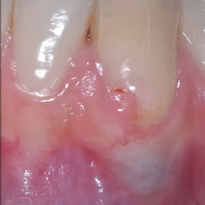 Lower Canine External Resorption - Image 3