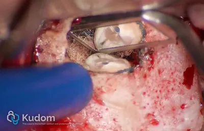 Microchirurgia Apicale Radice Mesio-Vestibolare di Molare Superiore - Immagine 3