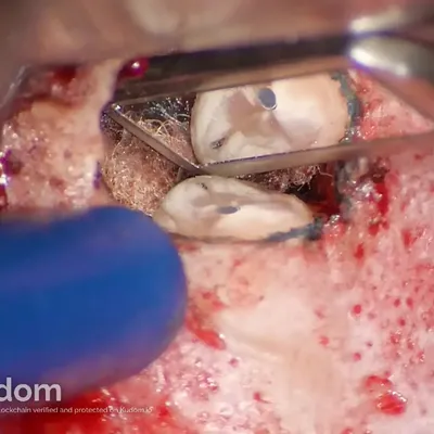 Apical Microsurgery of Upper Molar Mesiobuccal Root - Image 3