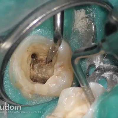 Complex Lower Molar Retreatment - Image 3