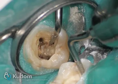 Ritrattamento Complesso Molare Inferiore - Immagine 3