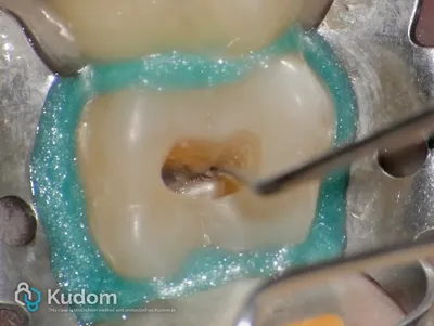 Terapia Canalare Molare Superiore - Immagine 4