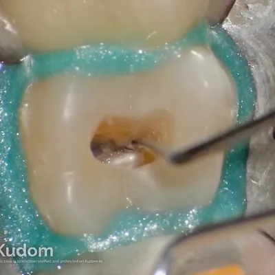 Upper Molar Root Canal Treatment - Image 4