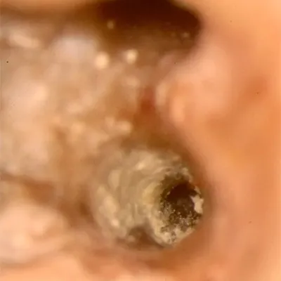 Lower Molar Iatrogenic Perforation - Image 4