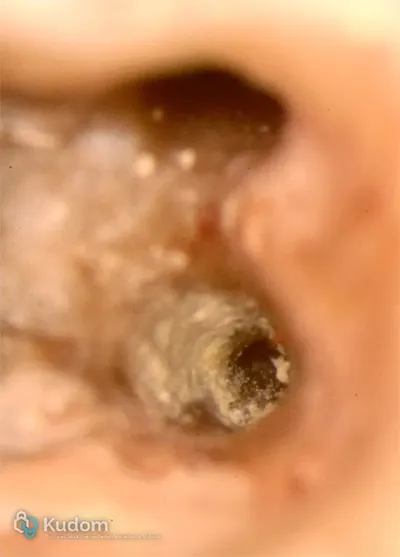 Perforazione Iatrogena Molare Inferiore - Immagine 4
