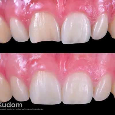 Upper Central Incisor Pulp Regeneration - Image 4