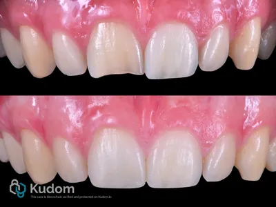 Rigenerazione Pulpare Centrale Superiore - Immagine 4