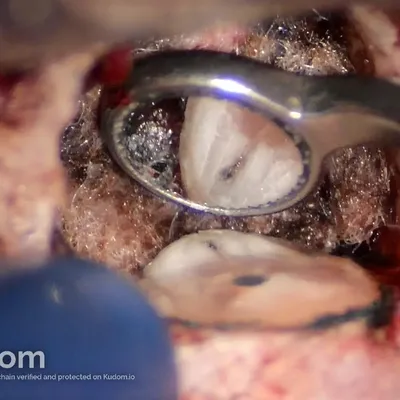 Apical Microsurgery of Upper Molar Mesiobuccal Root - Image 4