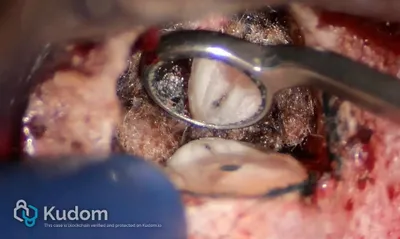 Microchirurgia Apicale Radice Mesio-Vestibolare di Molare Superiore - Immagine 4