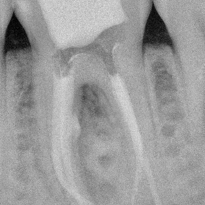 Complex Lower Molar Retreatment - Image 4