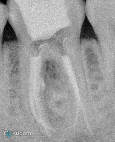 Ritrattamento Complesso Molare Inferiore - Immagine 4