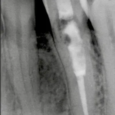Lower Canine External Resorption - Image 4