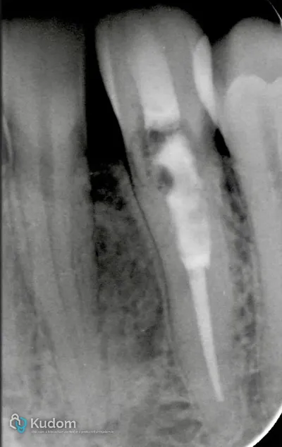 Riassorbimento Esterno Canino Inferiore - Immagine 4