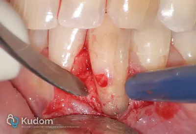 Riassorbimento Esterno Canino Inferiore - Immagine 5