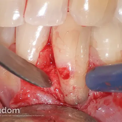 Lower Canine External Resorption - Image 5