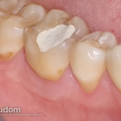Complex Lower Molar Retreatment - Image 5