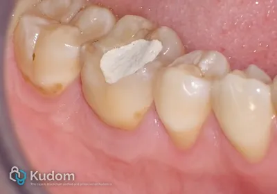 Ritrattamento Complesso Molare Inferiore - Immagine 5