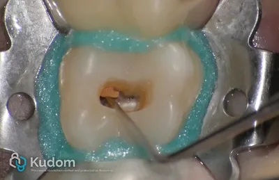 Terapia Canalare Molare Superiore - Immagine 5