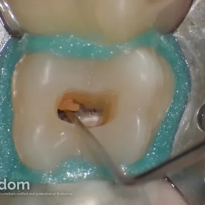 Upper Molar Root Canal Treatment - Image 5