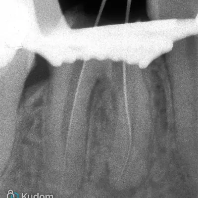 Lower Molar Iatrogenic Perforation - Image 5