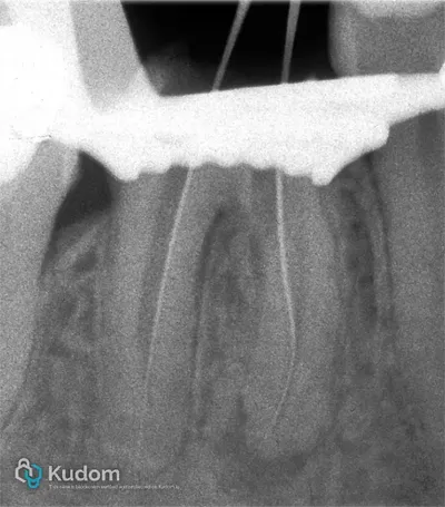 Perforazione Iatrogena Molare Inferiore - Immagine 5