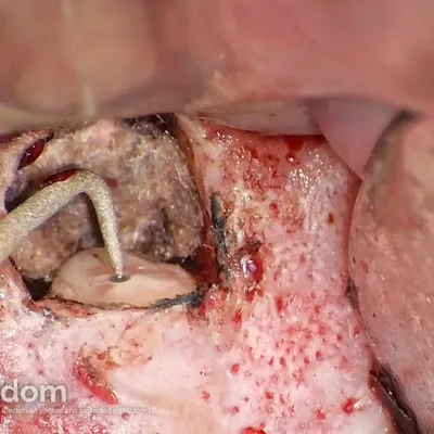 Apical Microsurgery of Upper Molar Mesiobuccal Root - Image 5