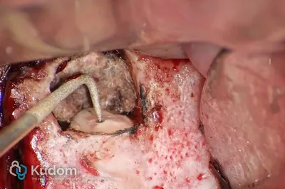 Microchirurgia Apicale Radice Mesio-Vestibolare di Molare Superiore - Immagine 5